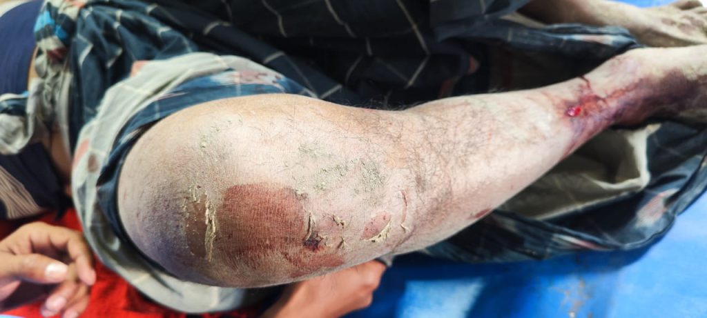 সালথায় কৃষকের ওপর হামলা