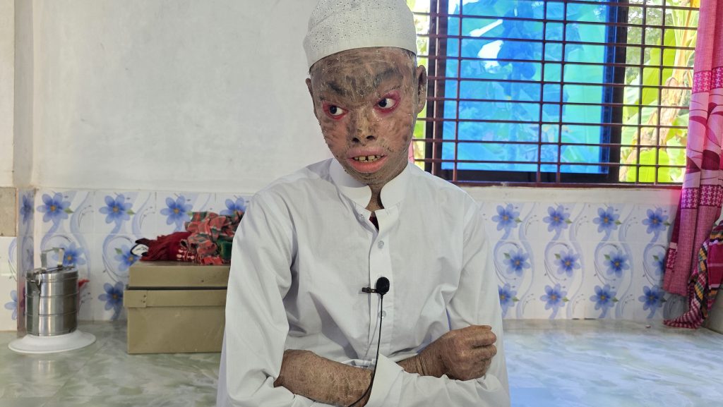 বিরল রোগে আক্রান্ত ফরিদপুরের নাঈম, টাকার অভাবে বন্ধ চিকিৎসা!