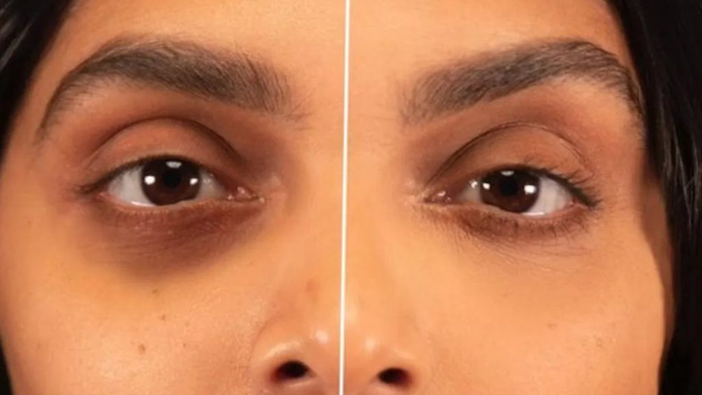 চোখের নিচের কালো দাগ কি মারাত্মক রোগের সতর্ক সংকেত? জানাচ্ছে গবেষণা