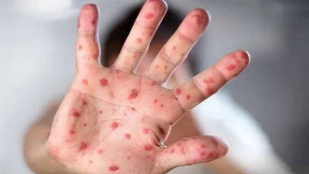 ফরিদপুরে হামের উপসর্গে ৭ মাসের শিশুর মৃত্যু, আতঙ্কে অভিভাবকরা